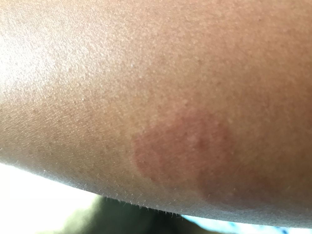 Day 4 of a group of bites